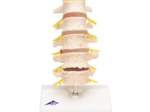 A – ARTHRITIC PINCH